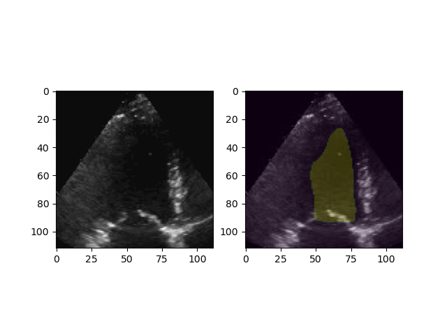 Segmentation of LV from ultrasound