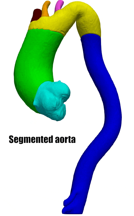 Model of aorta and stent implanatation
