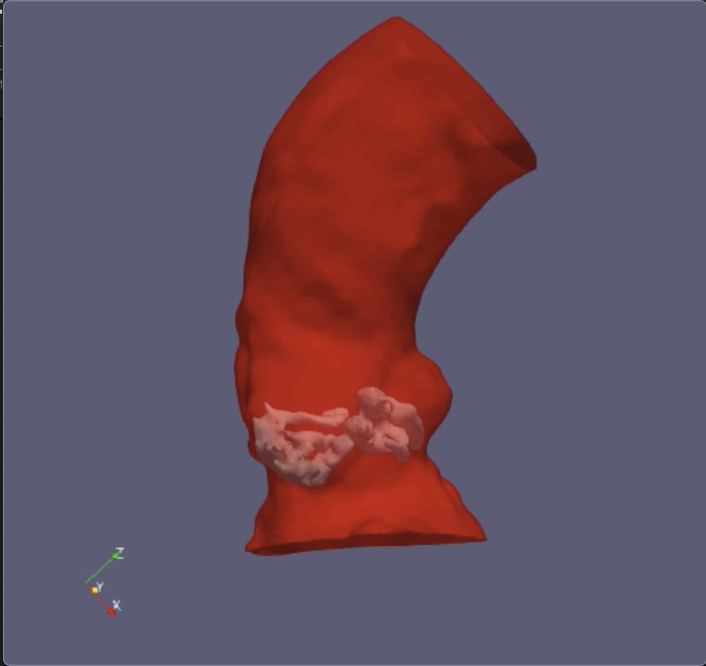 Calcified aorta model